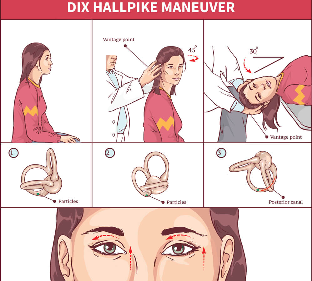 Vector illustation of Dix Hallpike manuever